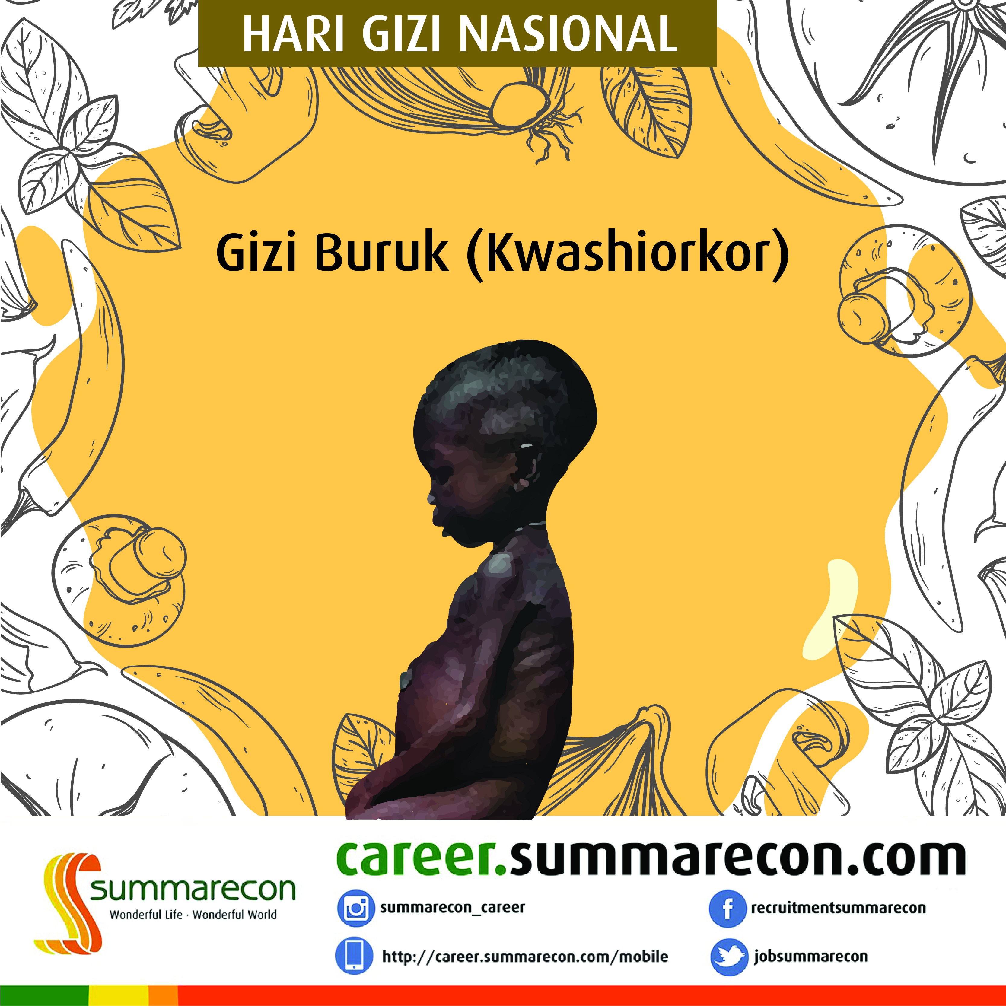 Trivia Gizi & Makanan - Gizi Buruk